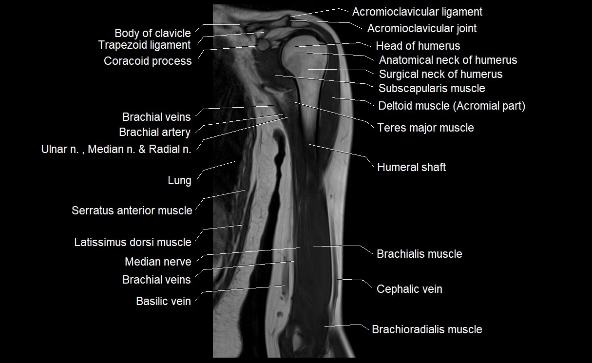 MRI upper arm (humerus ) coronal cross sectional anatomy image 11.webp